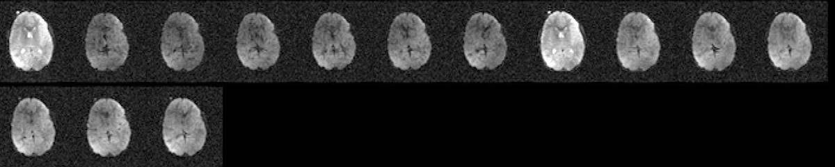 11.3 1. artifact image of coil sensitivity