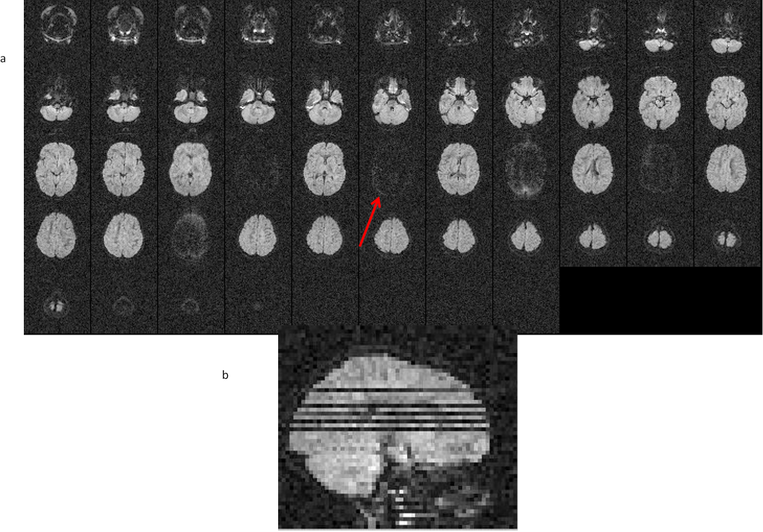 11.6. a,b image of Slice dropuout due to motion