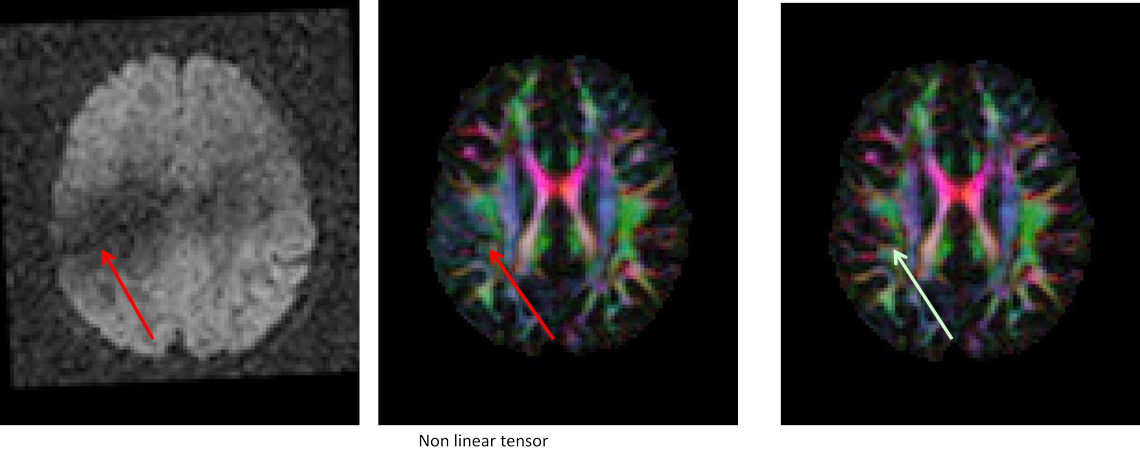 11.7. image of example of correction stages to remedy signal dropuout artifact in DIFFCALC