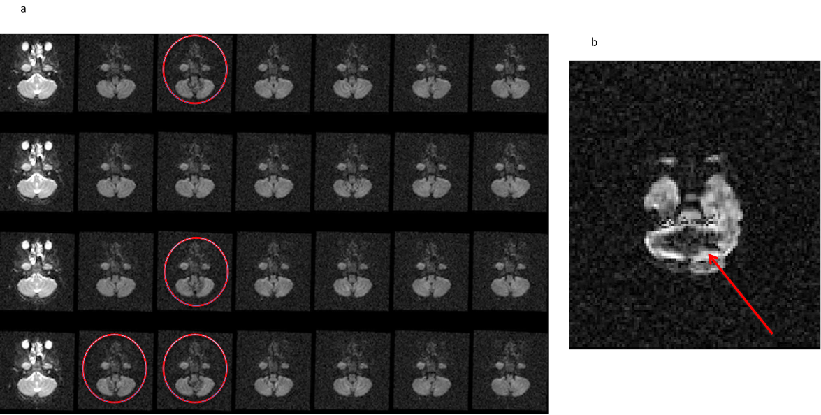 11.10. a,b image of Cardiac pulsation artifact