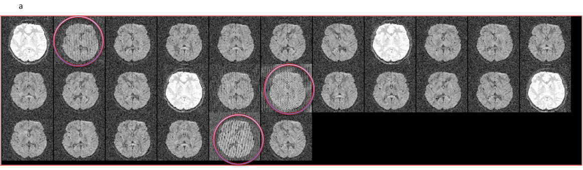 11.12. a. image of Spike/RF noise artifact